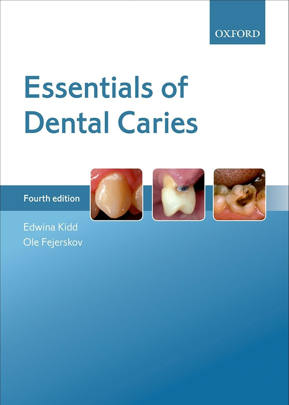 Essentials of Dental Caries