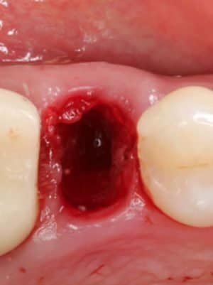 Extraction Socket – Preservation/Grafting; Immediate vs Delayed Implants; Pontic Site Development