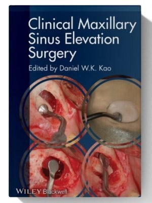 Clinical Maxillary Sinus Elevation Surgery 1st Edition