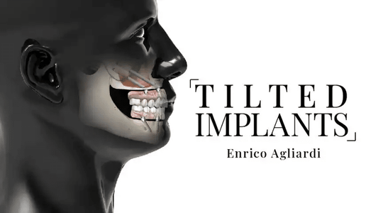 Angulated Dental Implants