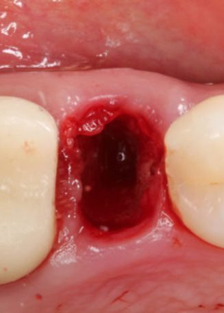 Extraction Socket – Preservation/Grafting; Immediate vs Delayed Implants; Pontic Site Development