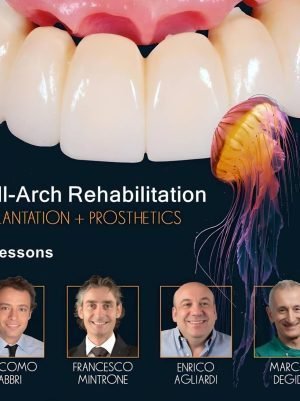 Full-Arch Rehabilitation: Implantation and Prosthetics