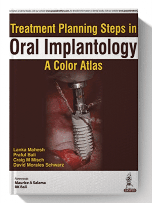 Treatment Planning Steps in Oral Implantology: A Color Atlas