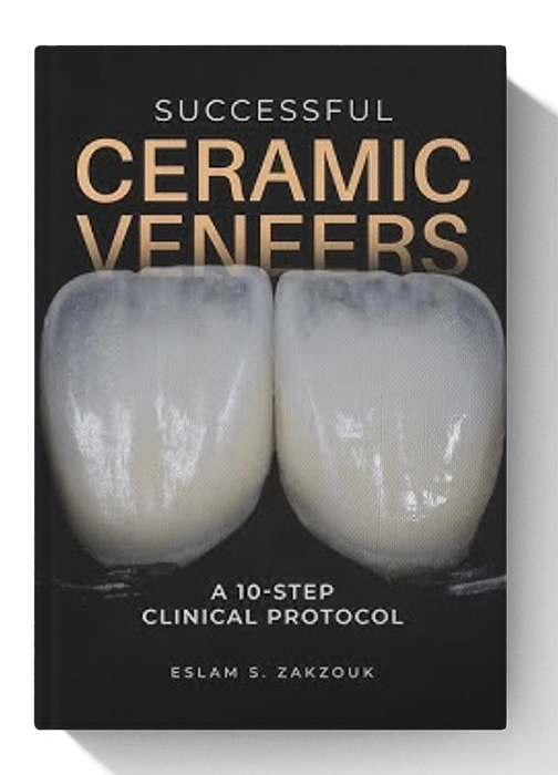 Successful Ceramic Veneers: 10 Steps Clinical Protocol