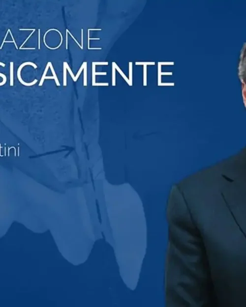 Rigenerazione Protesicamente Guidata: il nuovo modo di fare Rigenerazione che mette al centro il piano di trattamento protesico