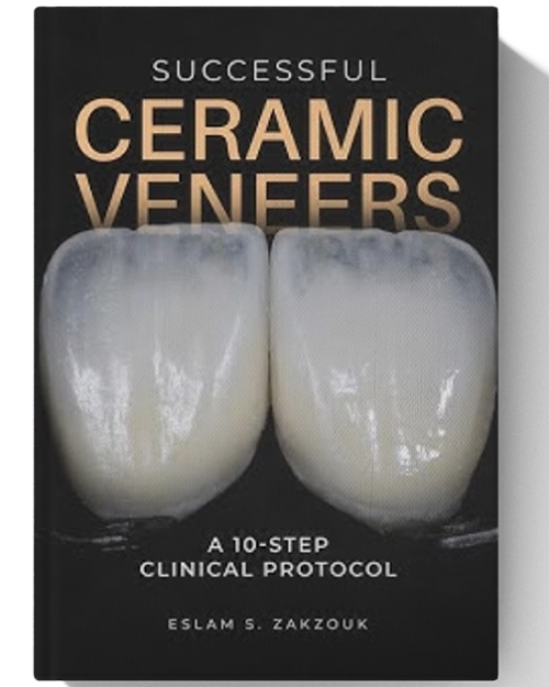 Successful Ceramic Veneers: 10 Steps Clinical Protocol