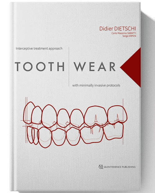 Tooth Wear: Interceptive Treatment Approach With Minimally Invasive Protocols
